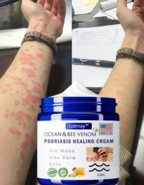 Bee Venom &Ocean Psoriasis Healing Cream (Pack Of 2)