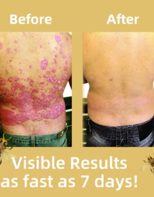 Bee Venom &Ocean Psoriasis Healing Cream (Pack Of 2)